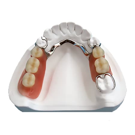 metal partial dentures