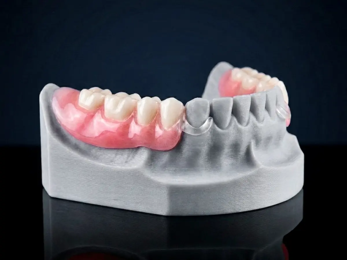 A high-resolution macro photograph showing a sophisticated lower partial denture precisely fitted onto a detailed 3D printed lab model of an lower jaw, demonstrating seamless adaptation and engineering precision at Confidentures in Auckland.