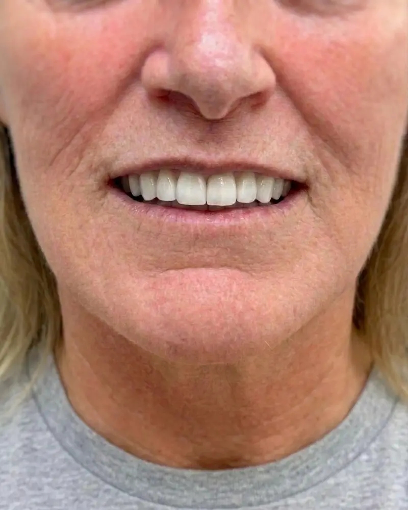 Clinical after photo of the same patient smiling, showing fully restored facial volume with an undetectable, premium cosmetic upper denture utilizing Ivoclar Phonares II composites.