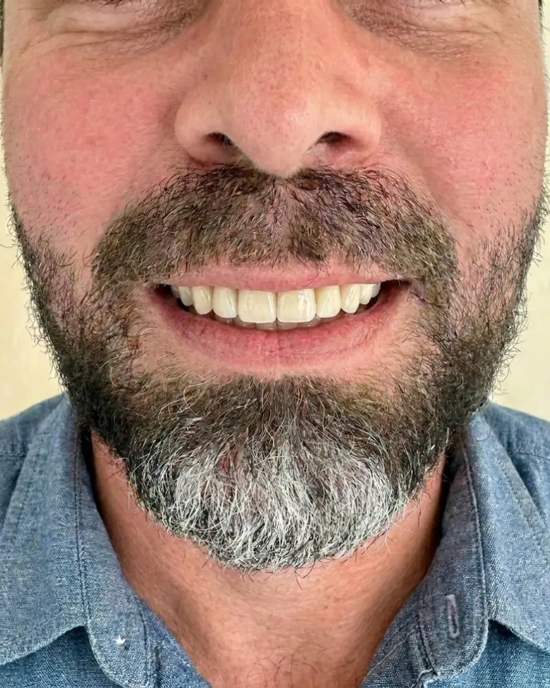 Clinical after photo of the patient smiling confidently, featuring a secure SEMCD denture and an ultra-thin precision-milled palate that successfully restores acoustic clarity and structural stability.