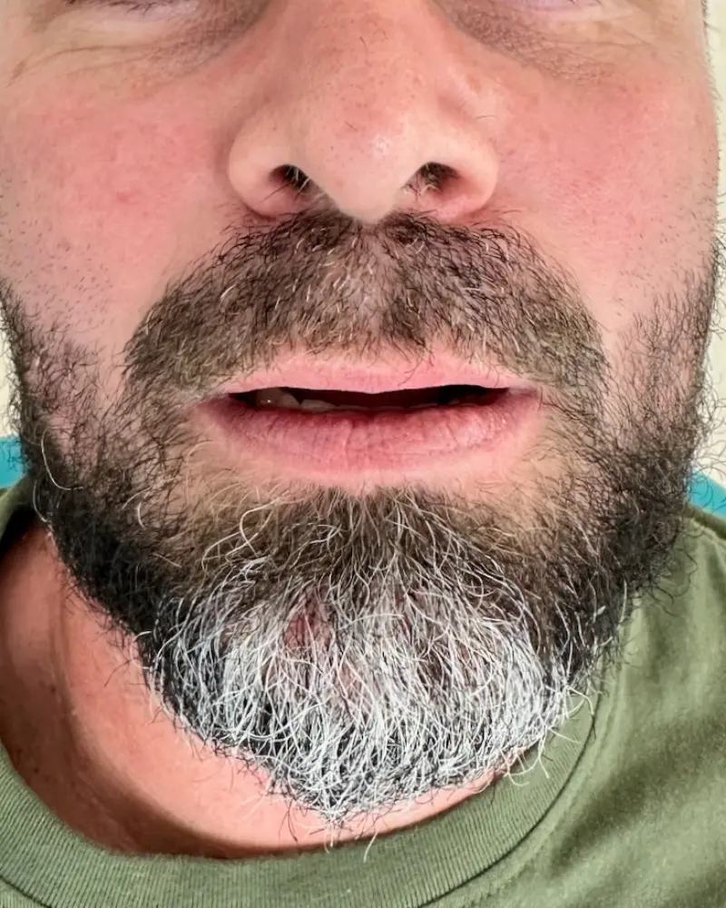 Clinical before photo of an executive patient requiring a mathematically stable prosthetic foundation to resolve chronic displacement and speech impediments.