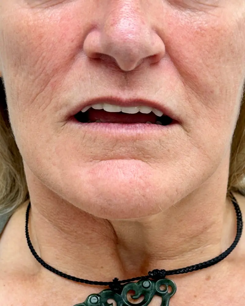 Clinical before photo showing a patient experiencing sunken lips and a loss of natural facial volume prior to receiving a complete upper cosmetic denture.