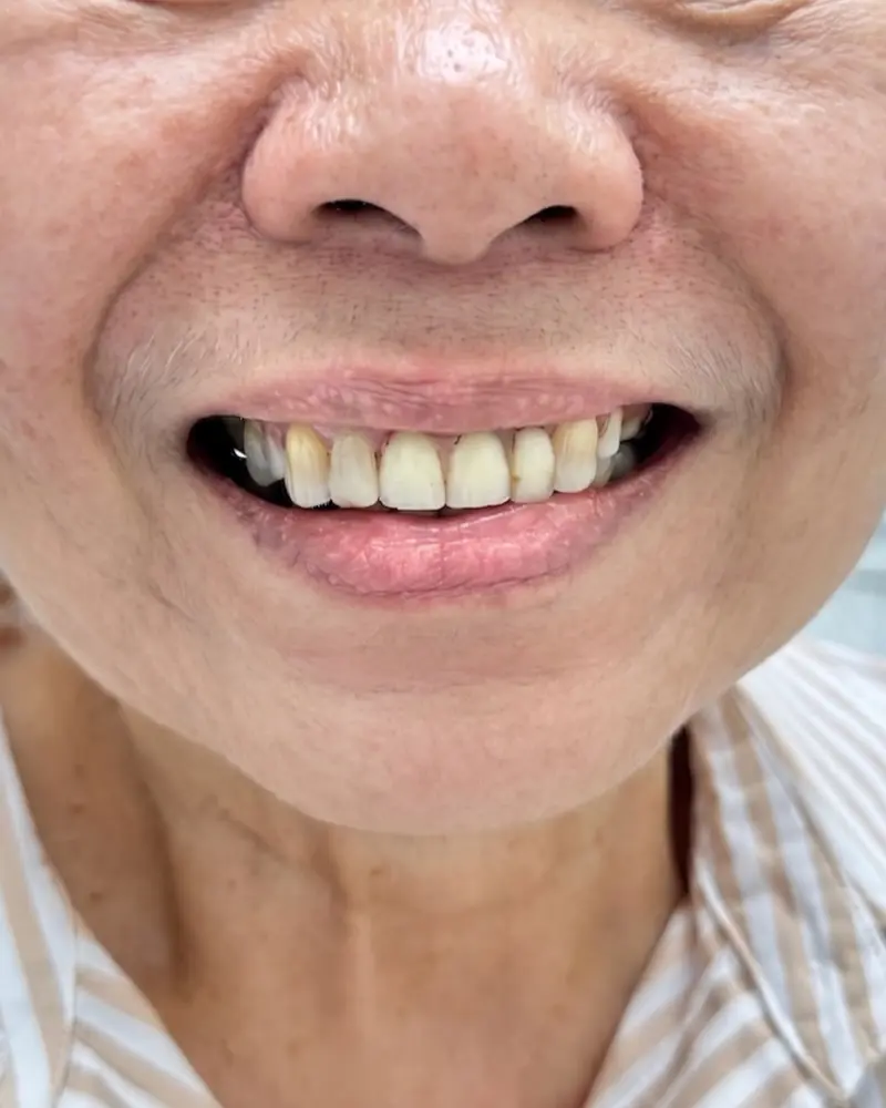 Clinical before photo of a patient wearing an older, poorly designed partial denture with an unsightly visible metal clasp on the front teeth.