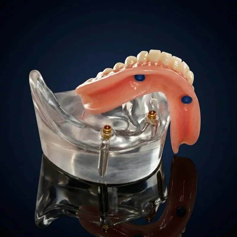 Macro view of a Confi-Overdenture hovering above a clear anatomical model with titanium dental implants. Milled with advanced VHF K5+ technology, this hybrid removable prosthetic snaps securely into place, providing patients with exceptional bite force and long-term bone preservation.