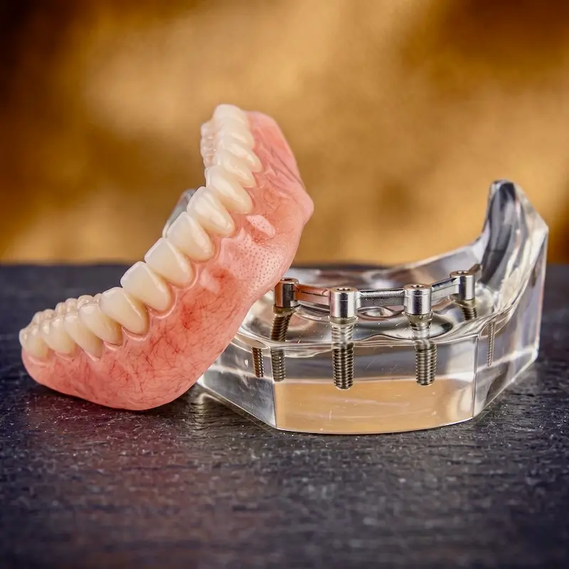 highly engineered digital denture from Confidentures, designed for unparalleled lower-suction stability and implant retention.