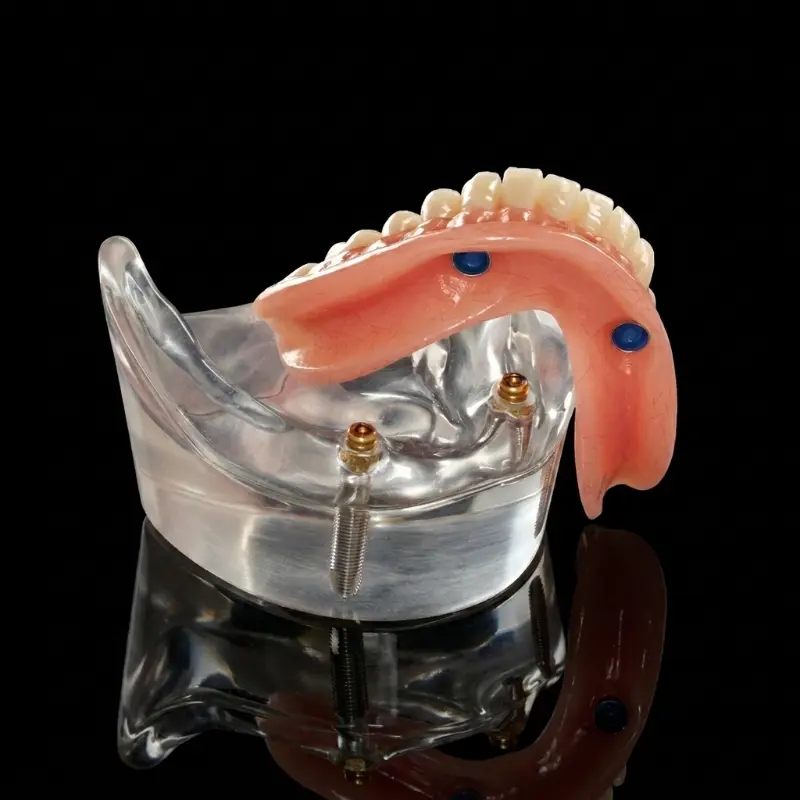 A clear clinical model showing a lower denture with locator attachments designed to snap securely onto dental implants, engineered for unrivaled stability at the Confidentures clinic in Silverdale.