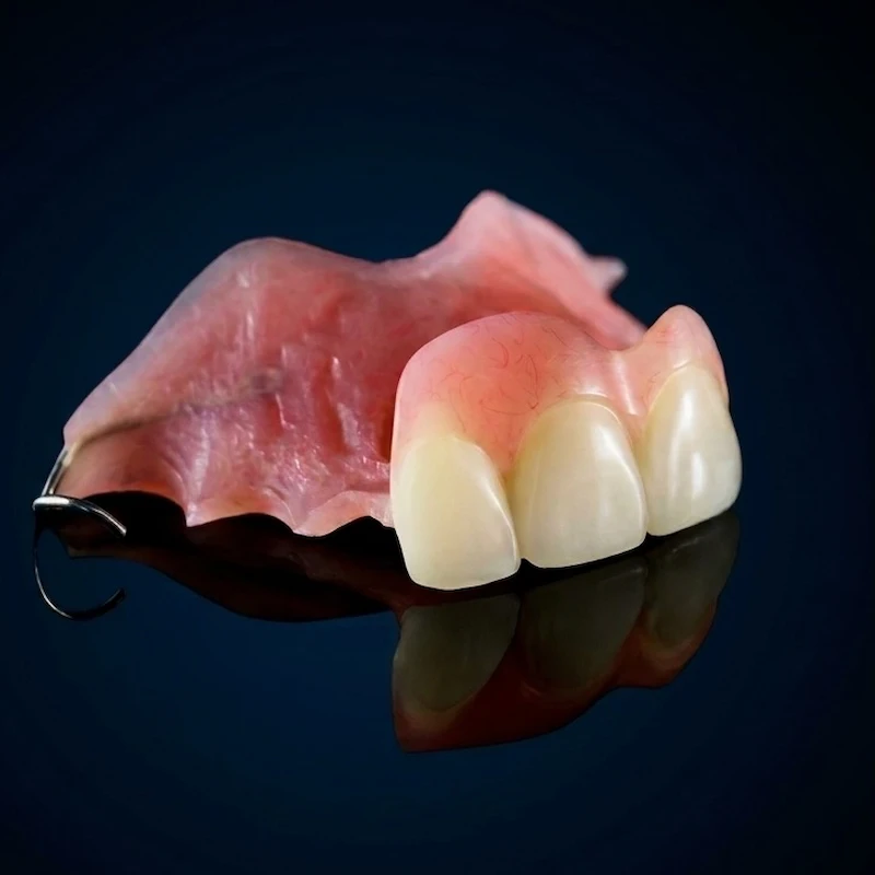 Precision-milled PMMA partial denture used for rapid deployment and post-extraction healing at Confidentures in Auckland.