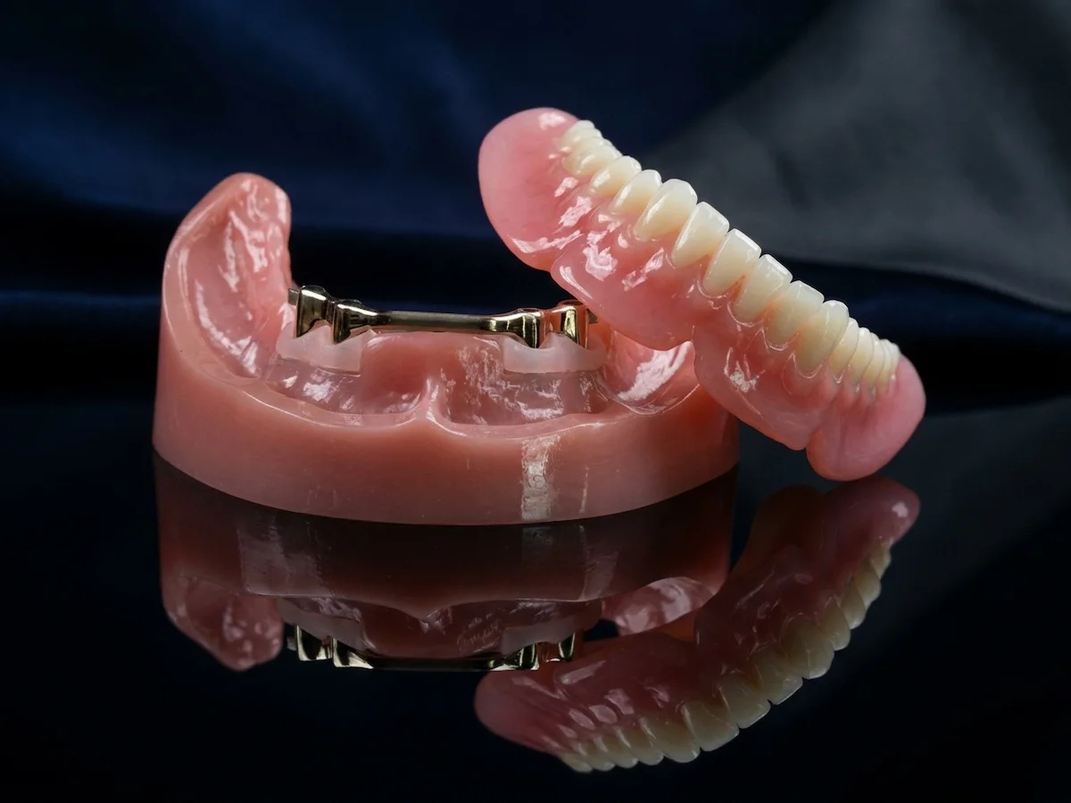 A premium implant overdenture hovering above a precision-milled retention bar, resting on a dark reflective surface. Engineered with advanced VHF K5+ technology at Confidentures in Auckland, this secure prosthetic delivers maximum bite force, flawless speech acoustics, and absolute structural stability for demanding lifestyles.