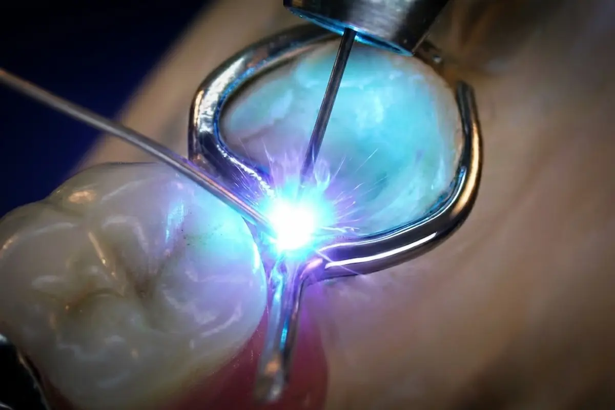 Extreme macro photograph demonstrating precision industrial laser welding on a titanium partial denture framework. Confidentures in Auckland utilizes advanced fusion technology to provide immediate, structurally sound, non-mass-produced urgent repairs in demanding scenarios.